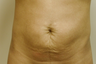 SmartLipo Abdomen