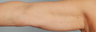Smart Lipo