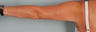 Smart Lipo Brachial