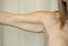 Laser Liposuction