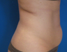 Smart Lipo