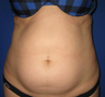 Smart Lipo