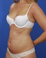 Laser Liposuction
