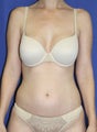 Laser-assisted Liposuction