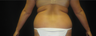 SmartLipo/MPX Flanks