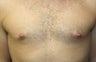 Smart-Lipo of the Chest, Liposuction, Gynecomastia