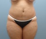 Liposuction to Full Abdomen and Full Back