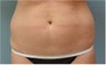 SmartLiposuction