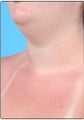 Smart Lipo, Neck Liposuction