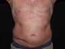 Smart Lipo Abs and Flanks