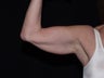 Smart Lipo Arms