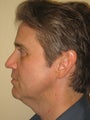 42 year old male before and after SmartLipo of the neck