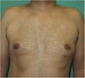 29 Year Old Male Treated for Gynecomastia with Smart Lipo Triplex
