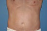 Smartlipo