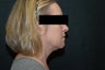 SmartLipo MPX Neck and Jowls