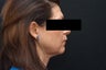 SmartLipo MPX Neck/Jowls