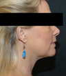 SmartLipo MPX neck and jowls