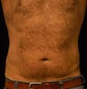 Liposucction of the Abdomen and Waist using Smart Lipo MPX