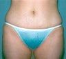 Smartlipo