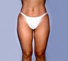 Smartlipo
