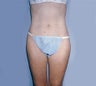 Smartlipo