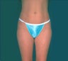 Smartlipo