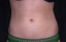 Smartlipo