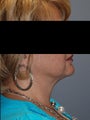 SmartLipo Neck