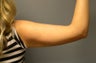 SmartLipo