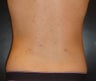 Smartlipo PRO-Sculpt