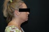 SmartLipo MPX Neck and Jowls