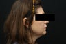SmartLipo MPX Neck/Jowls