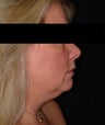 SmartLipo MPX neck and jowls
