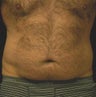Liposucction of the Abdomen and Waist using Smart Lipo MPX