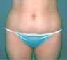Smartlipo
