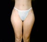 Smartlipo