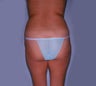 Smartlipo