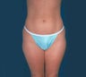 Smartlipo