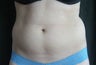 Smartlipo