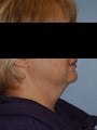 SmartLipo Neck