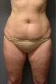SmartLipo