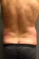SmartLipo
