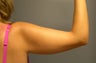 SmartLipo