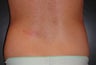 Smartlipo PRO-Sculpt