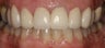 porcelain crowns and porcelain veneers