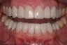 replacement of old restorations and new smile design