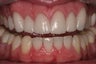 porcelain crowns