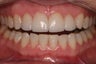 porcelain crowns to close space