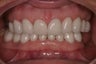 full mouth rehab