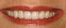Veneers